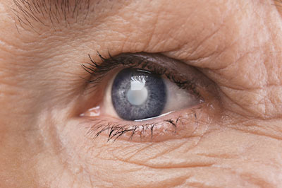 Vision World Bay Shore | Contact Lens Exams, Macular Degeneration and Cataracts